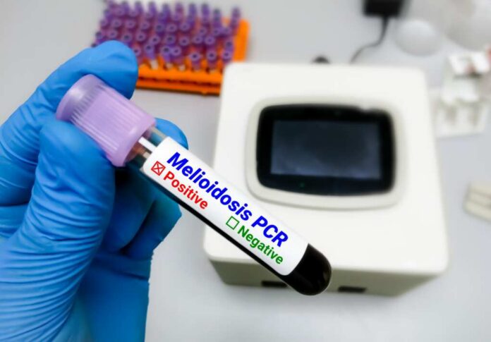 Blood,Sample,For,With,Melioidosis,Pcr,Test,,Also,Called,Whitmore's A hand holding a blood sample tube labeled Melioidosis PCR Positive with laboratory equipment in the background